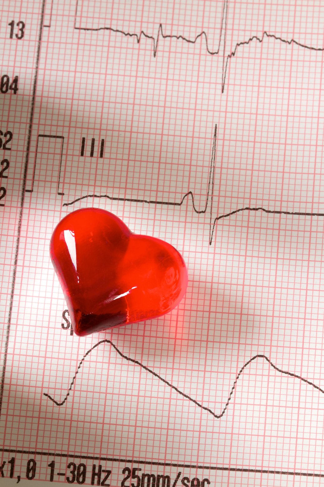 ECG Electrocardiogram